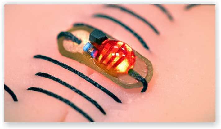 Smart sutures that detect infections